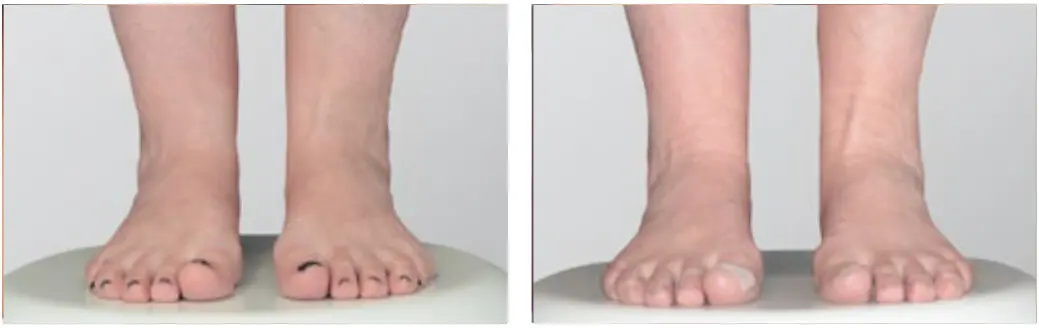 دستگاه لیزر اندولیفت (Lasemar1500) 24 ankle